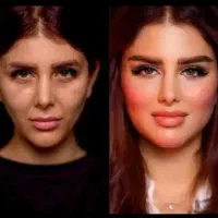 ژل و بوتاکس ،تخلیه وتزریق چربی