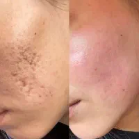 میکرونیدلینگ/مزونیدلینگ تخصصی صورت در قم
