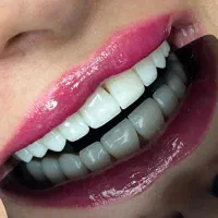 کامپوزیت ،لمینیت،ایمپلنت،اقساط بدون سودوکارمزد