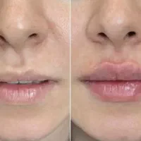 آفر ویژه خدمات زیبایی بوتاکس،فیلر،مزوژل جوانساز،نخ