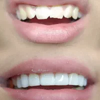 خدمات کامپوزیت زیبایی و نچرال