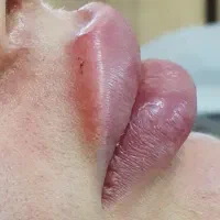 کانتورینگ ، لیفت،بوتاکس و ژل لب ،زاویه سازی صورت