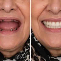 ایمپلنت + روکش لمینتی ۱۶.۸۰۰