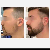 قطع ریزش مو بدون به صورت ریشه ای بدون بازگشت