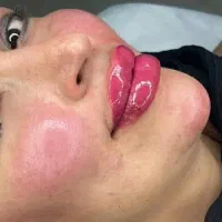 ژل و بوتاکس سیسی 1200