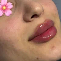 تزریق ژل و بوتاکس لیفت با نخ