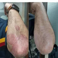 بهبود پاکسازی بدن از مشکلات پوستی