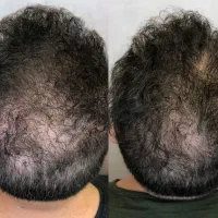موهات کم پشت شده