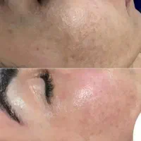 فشیال پاکسازی صورت ودست و....