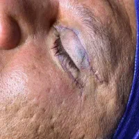بلفـاروپلاسـتی‌پلک بالاوپایین با بخیه لیزری/اقساط