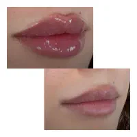 تزریق فیلر یا ژل لب در منزل