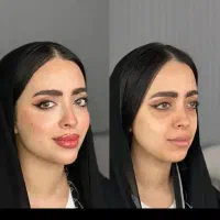 ژل و بوتاکس تضمینی