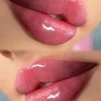 آف فیلر لب هر سی سی فقط ۳/۵ میلیون تزریق توسط پزشک