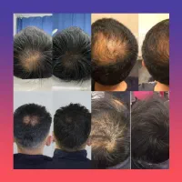 کاشت خانگی موی سر توی ۲۰ روز