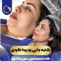 آف 50% ساکشن غبغب سوپر کانتور VLine بدون عمل جراحی