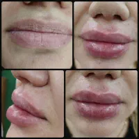 ژل لب|خدمات زیبایی و سلامت|پردیس, فاز ۱۱|دیوار