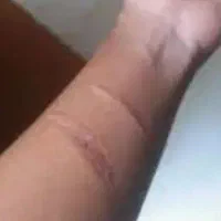 پزشکی. درمان خودزنی و جای زخم