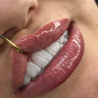 کامپوزیت دندان شرایط اقساط