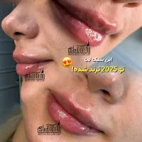 تزریق فیلر-بوتاکس-جوانسازی صورت