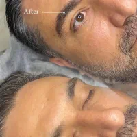 رفع تیرگی لب،میکرو بلیدینگ آقایان‌ نچرال،اسکالپ سر
