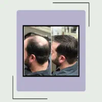 بدون نیاز به کاشت