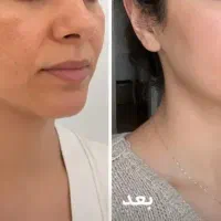 کرم ضدلک (ارسال رایگان)