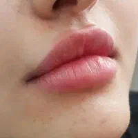 ژل بوتاکس فیلر متد روسی مید فیس جوانساز