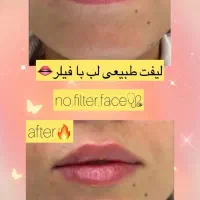 انجام کلیه خدمات زیبایی تزریقات