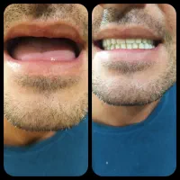 دندان مصنوعی(پرتز متحرک)دندانسازی