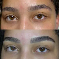 میکروبلیدینگ ، شیدینگ ، اسکالپ