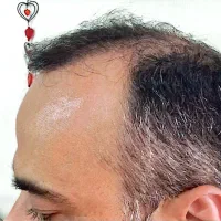 کاشت مو با تراکم بالا و تضمینی بدون درد