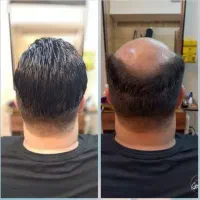 پروتزموی رویان