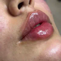 خدمات ژل و بوتاکس