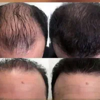 با انجام درمان هایی که ما میگیم ریزش مو برطرف میشه