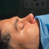عمل بینی..|خدمات آرایشگری و زیبایی|آمل, |دیوار
