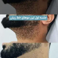 لیزر رایگان/آقا/خانم/باقویترین دستگالیزرموزائد۲۰۲۶