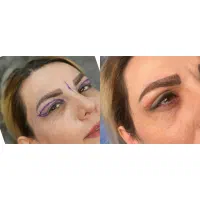 بلفارو پلاستی و دایرکت ابرو
