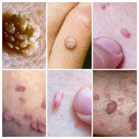 درمان hpv و hsv و منگوله