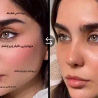 ژل لبM و بوتاکس990 پروفایلو جوانساز ۹۸۰۰
