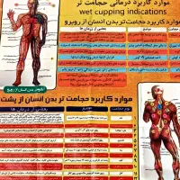 حجامت و زالو درمانی