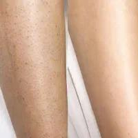 لیزر  فیشال خالبرداری الکترولیز و ...