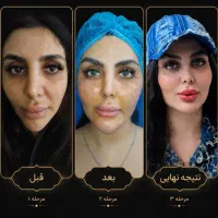 مرکز تخصصی تزریق چربی/بوتاکس/ژل لب لیفت شقیقه