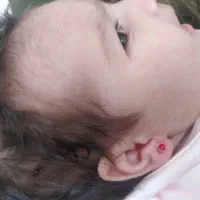 سوراخ کردن گوش و برداشتن خال