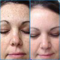 درمان کبد چرب به صورت ریشه ای و قطعی