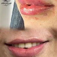 تزریق فیلر و بوتاکس توسط پزشک با بازگشت هزینه