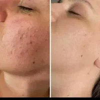 جشنواره۵۰درصد تخفیف ویژه فیشیال فقط ۳۰۰ هزار تومان