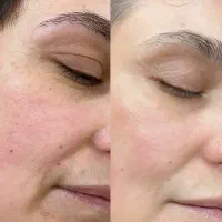 کرم جوانه گندم (جایگزین بوتاکس)