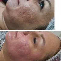 لیزرکیوسوییچ وایتینینگ پاکسازی هالیوودی سفید کننده