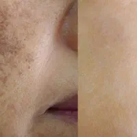 پوست آیینه ای و درخشان با یک دوره درمان