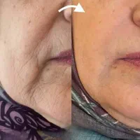 بوتاکس ولیفت طبیعی صورت باروغن تراپی